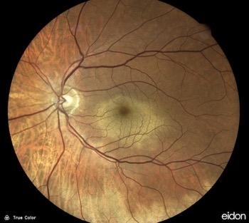 Photograph of retina